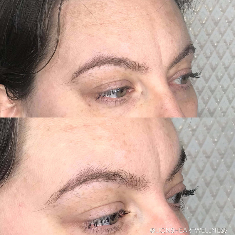 Cosmetic Facial Acupuncture Before and After forehead wrinkle treatment
