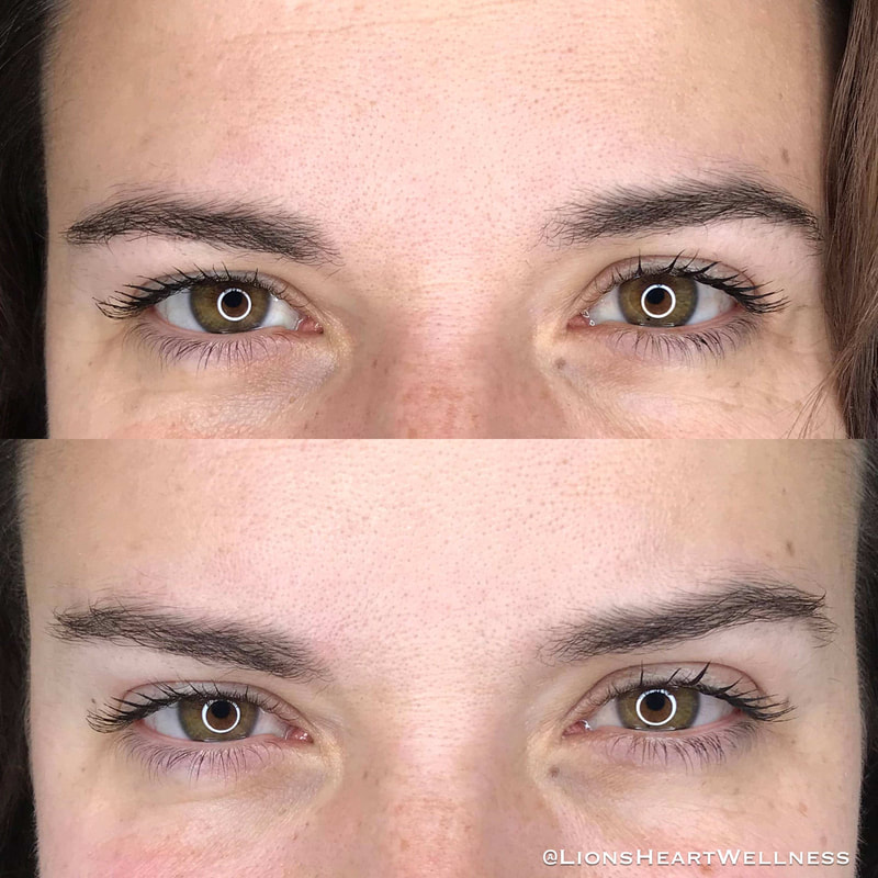 Cosmetic Facial Acupuncture Before & After Photos - Crow's Feet and Under Eye Dark Circles and Puffiness Dr Kim Peirano San Rafael Marin County 
