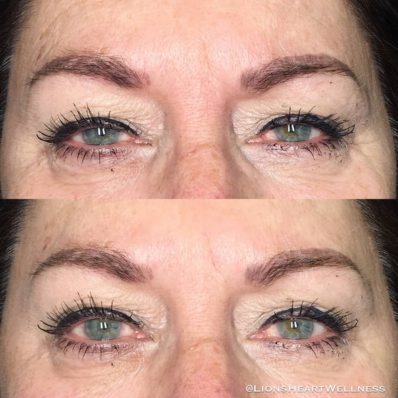 Cosmetic Facial Acupuncture Before & After Photos - Crow's Feet and Under Eye Dark Circles and Puffiness Dr Kim Peirano San Rafael Marin County 