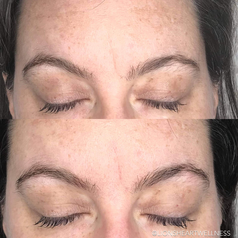 Cosmetic Facial Acupuncture Before and After forehead wrinkle treatment
