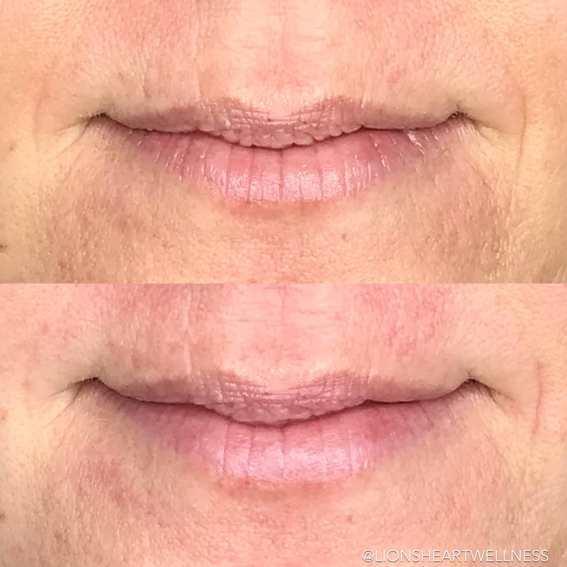 Cosmetic Facial Acupuncture Before and After Photo Dr Kim Peirano San Rafael CA Jowl and Cheek Lift