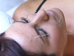 close up photo of cosmetic facial acupuncture treatment with dr kim peirano
