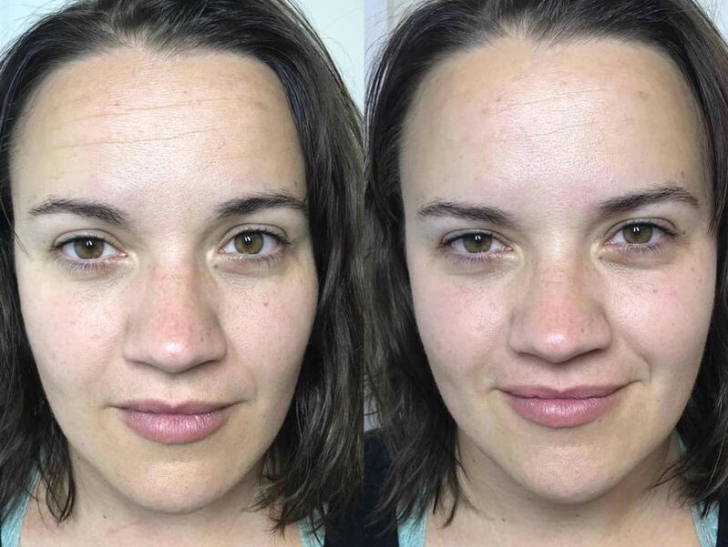 before and after cosmetic facial acupuncture progress