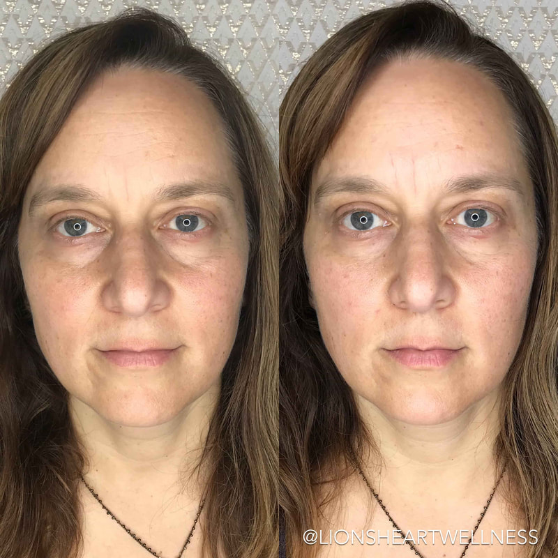 Cosmetic facial acupuncture before and after full face 