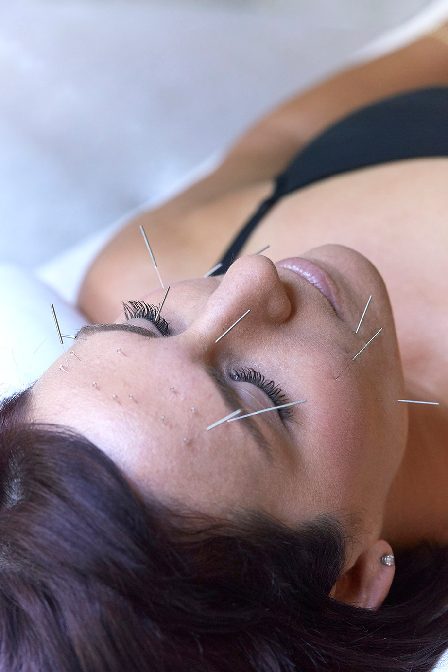 Cosmetic Facial Acupuncture with Dr Kim Peirano San Rafael CA Cosmetic Facial Acupuncture Treatment with Needles