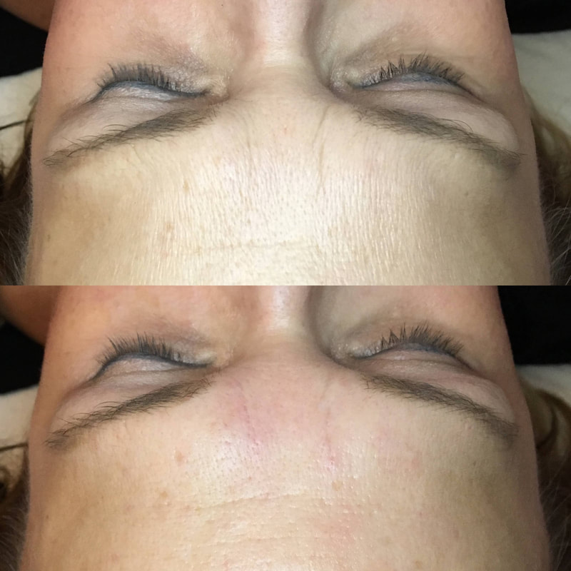 Cosmetic Facial Acupuncture Before & After Photos - Furrow '11' Lines and Forehead Wrinkles Dr Kim Peirano Acupuncture San Rafael