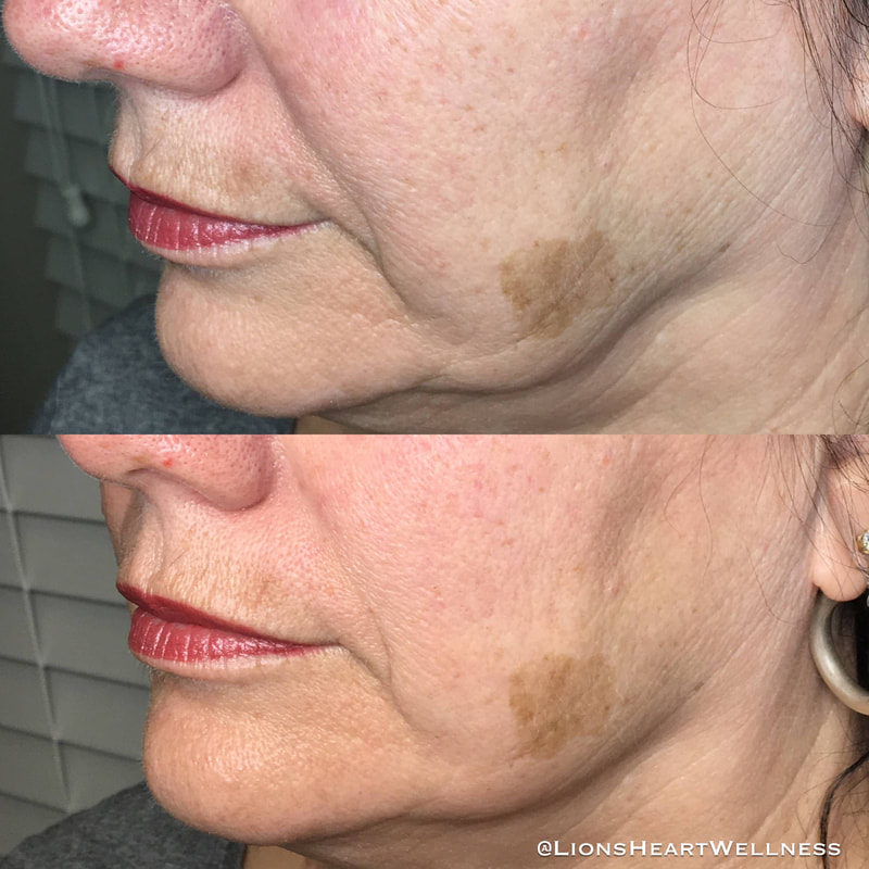 Cosmetic Facial Acupuncture Before and After Photo Dr Kim Peirano San Rafael CA Jowl and Cheek Lift
