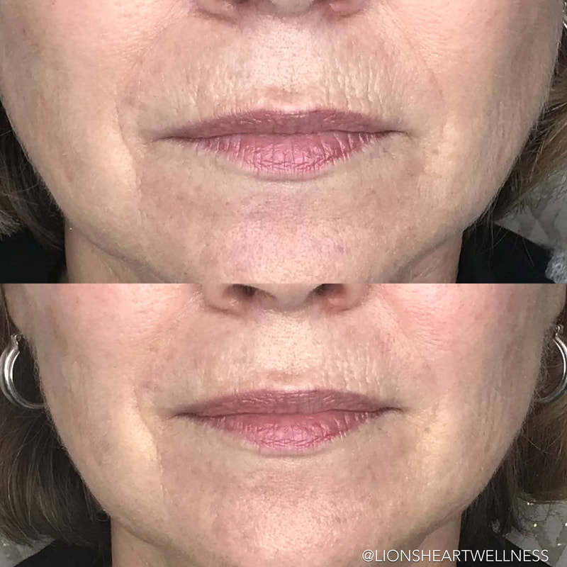 Cosmetic Facial Acupuncture Before and After Photo Dr Kim Peirano San Rafael CA Lip Plumping Acupuncture and Lip Wrinkle Treatment