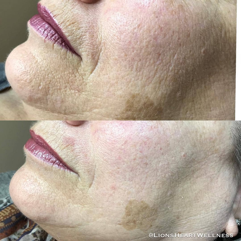 Cosmetic Facial Acupuncture Before and After Photo Dr Kim Peirano San Rafael CA Microneedling Treatment Skin Texture Treatment