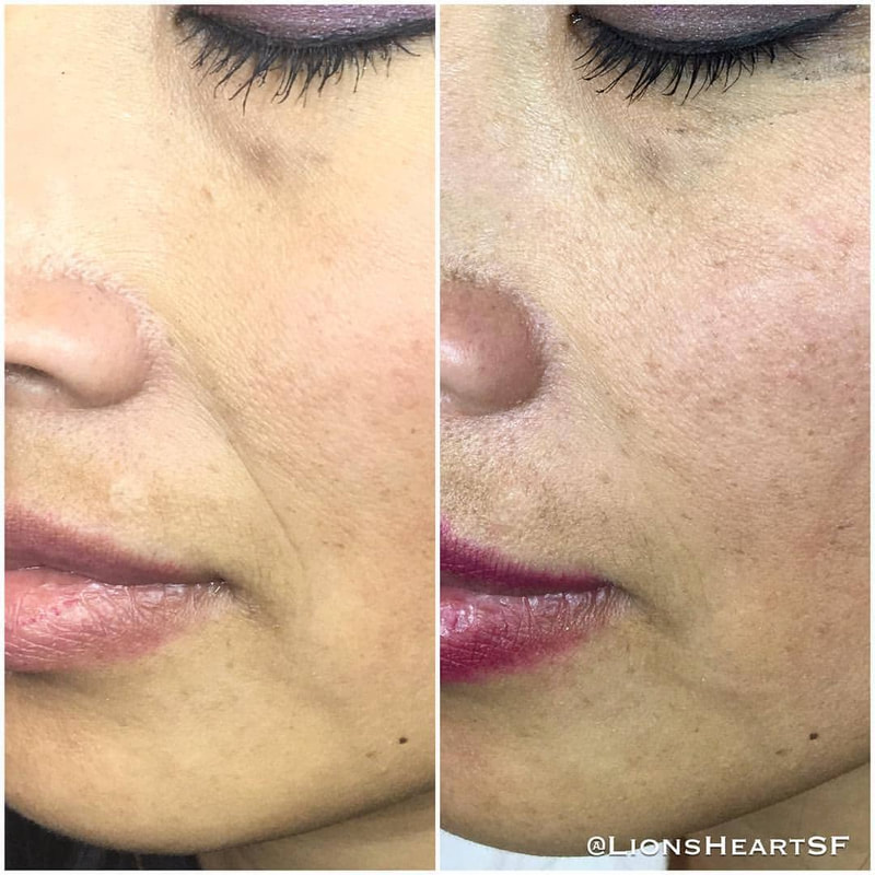 Cosmetic Facial Acupuncture Before and After Photo Dr Kim Peirano San Rafael CA Nasolabial groove cheek fold wrinkle treatment