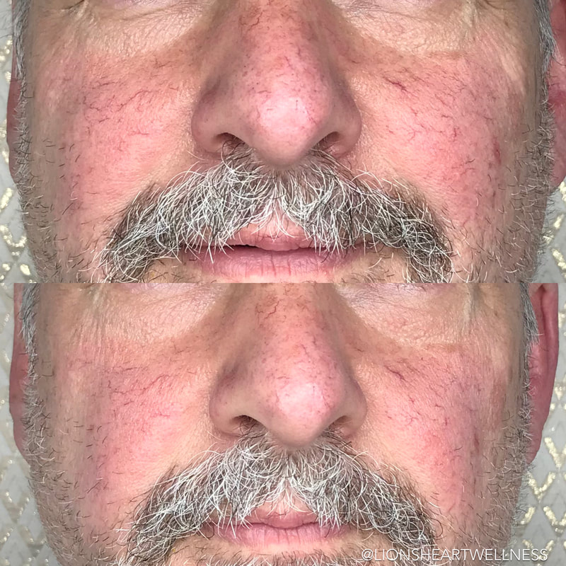 Cosmetic Facial Acupuncture Before and After Photo Dr Kim Peirano San Rafael CA Rosacea Treatment