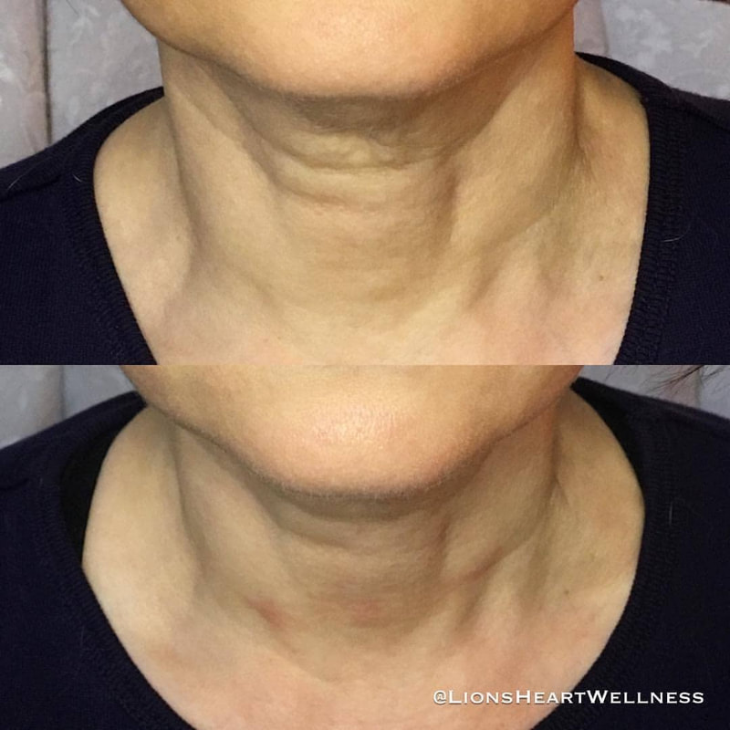 Cosmetic Facial Acupuncture Before and After Photo Dr Kim Peirano San Rafael CA Neck Lift