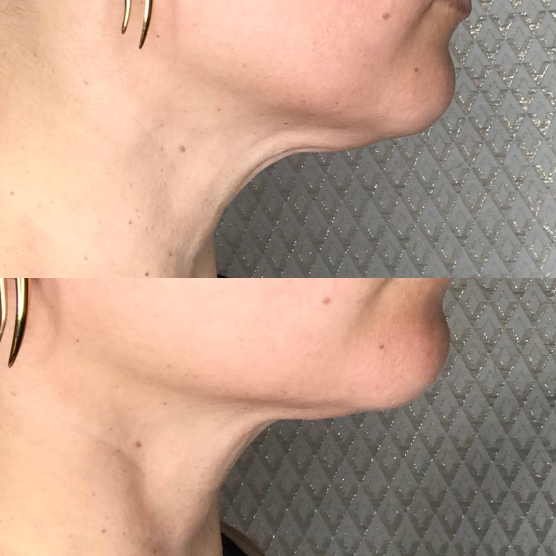 Cosmetic Facial Acupuncture Before and After Photo Dr Kim Peirano San Rafael CA Natural Neck Lift
