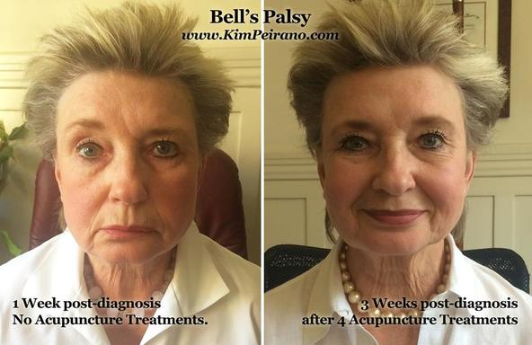 Cosmetic Facial Acupuncture Before and After Photo Dr Kim Peirano San Rafael CA Bell's Palsy Facial Paralysis Acupuncture Treatment 